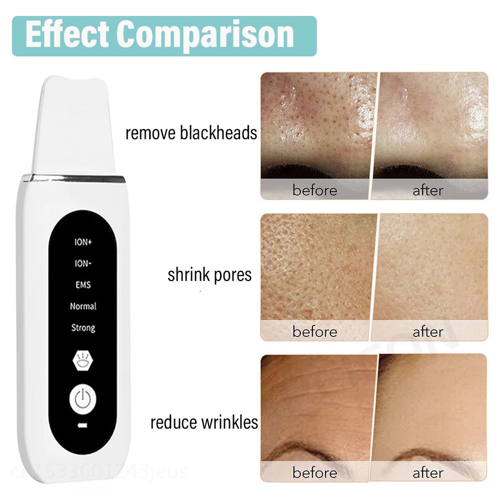 Skin Scrubber Peeling Blackhead Remover - Glowify Essentials